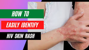 how to identify an hiv rash you