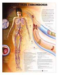 Deep Vein Thrombosis Anatomical Chart