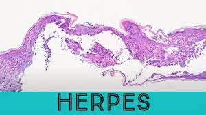 pathology outlines herpes simplex virus