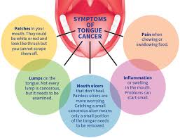 tongue cancer more young women falling