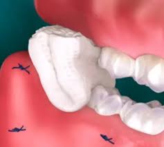 after wisdom tooth removal coppell tx
