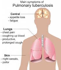 Tuberculosis, infectious disease caused by mycobacterium tuberculosis. Tuberculosis A Romanticized Disease Future Science Leaders
