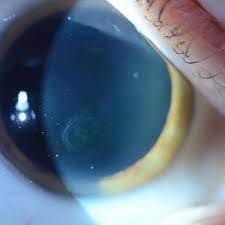 Recur Corneal Erosions