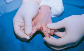 He was born with a condition called poland syndrome, named after british surgeon alfred. Poland Syndrome Hand