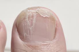 nail disorders archives thomas
