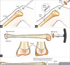 insertion of the tibial nail