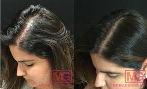Micro needling targets the deeper layer of your skin called the dermis where it initiates the healing response and causes collagen formation. Hair Loss Nyc Dermatologist Specialist Guide To Hair Loss Treatment Options
