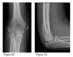Although epicondylitis implies an inflammatory process, inflammatory cells are not identified histologically. How To Avoid Missing A Pediatric Elbow Fracture Acep Now