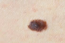 symptoms of skin cancer the