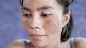 how to remove dark spots caused by