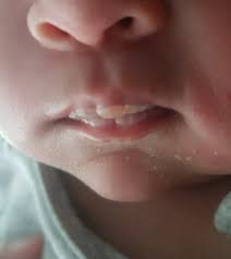 blister on baby s lips babycentre