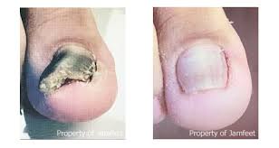 before and after toenail photo tower