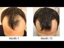 alopecia areata home remes