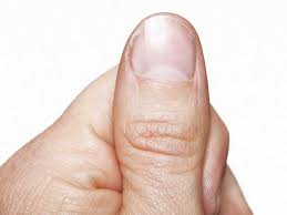 nail pitting causes treatment and more