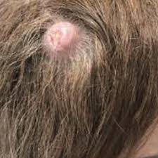 lump in scalp its types causes and