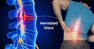 herniated disc take to heal