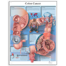 Colon Cancer Medical Posters Colon Cancer Anatomy Charts