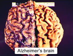 cns aging and alzheimer s disease