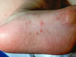 viral rash types symptoms causes