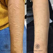 scar camouflage scar removal and scar