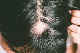 how hormones contribute to hair loss