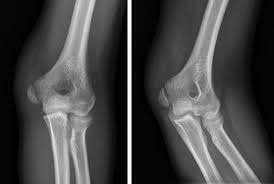 Fractures of the lateral epicondyle are unusual and typically arise from a fall on an outstretched hand or a direct blow 6. Medial Epicondyle Fracture Springerlink