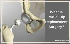 partial hip replacement surgery