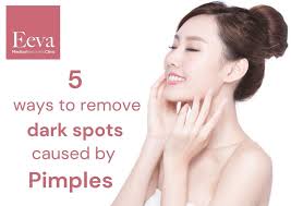 dark spots caused by pimples