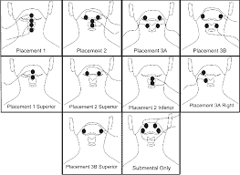 Figure 1 From The Effect Of Surface Electrical Stimulation