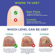 toe nail fungus treatment