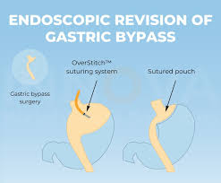 gastric byp revision in new york and