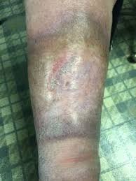 It has been updated as of january 2020. Skin Diseases Of The Foot Foot Skin Diseases Bv Foot Clinic
