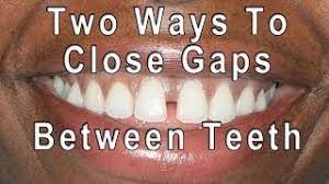 The teeth push the lip up as they tip forward. How To Get Rid Of Gaps In Teeth 14 Steps With Pictures