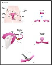 tubal ligation procedure recovery