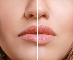 non surgical lip enhancement duration