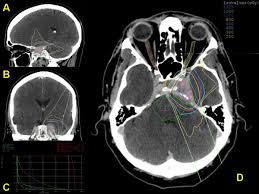 radiosurgery with photons or protons
