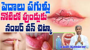 what causes chapped lips ప ద ల