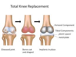 painful knee replacement revision