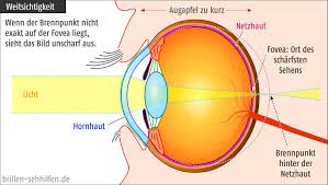 Bildergebnis für augen Kurzsichtigkeit bilder