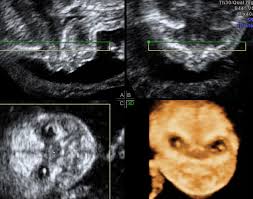 ultrasound imaging of the fetal palate