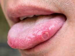 blisters on the tongue pictures