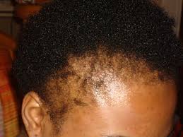 Find the perfect hair falling out stock photos and editorial news pictures from getty images. Black Woman Alopecia All You Need To Know About The Hair Disease