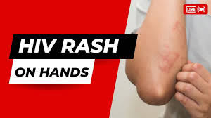 hiv rash on hands you