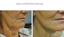 can-botox-fix-neck-lines