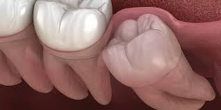 wisdom teeth removal procedure san