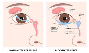 blocked tear duct surgery