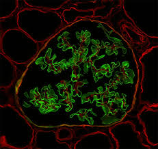 Pathology Outlines Alport Syndrome