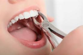 Dentures are removable false teeth made of acrylic (plastic), nylon or metal. How To Prepare For A Tooth Extraction