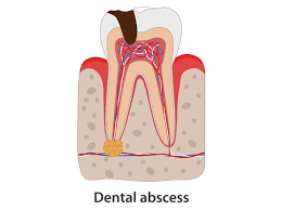 how long does it take for an abscess to