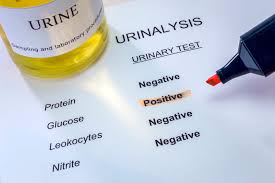 sugar in urine what you should know